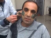 Yanak Ağdası Kullanımı ve Faydaları Nelerdir?