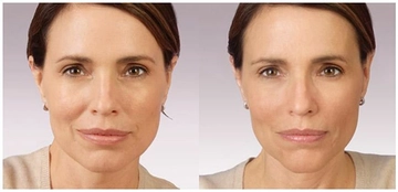 Yanak Çökmesi Belirtileri ve Tedavisi